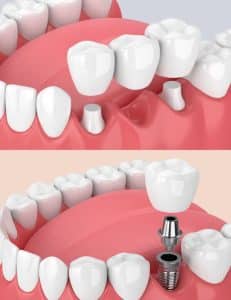 découvrez comment limer efficacement une couronne dentaire pour garantir un ajustement parfait et un confort optimal. apprenez les techniques et conseils d'experts pour maintenir la qualité de votre restauration dentaire.